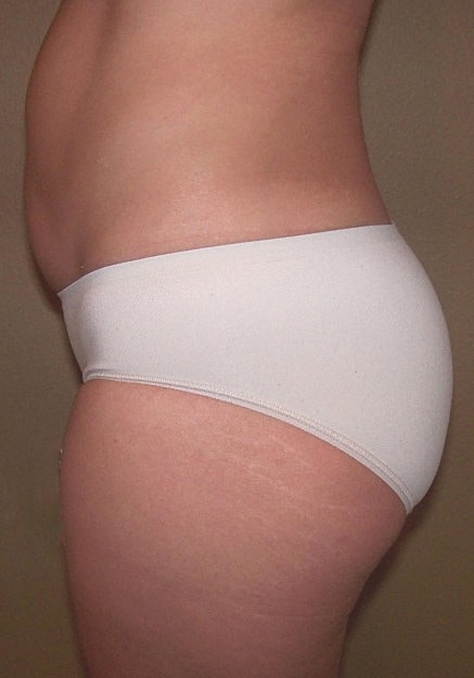 Brazilian Butt Lift Before & After