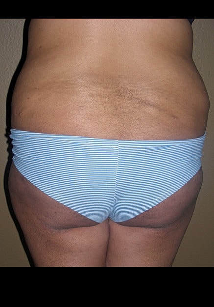 Brazilian Butt Lift Before & After