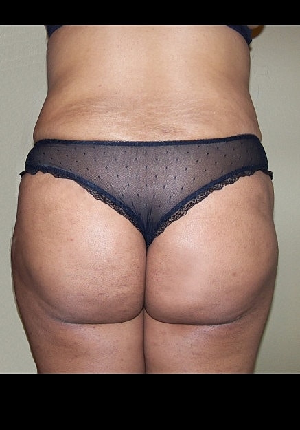 Brazilian Butt Lift Before & After