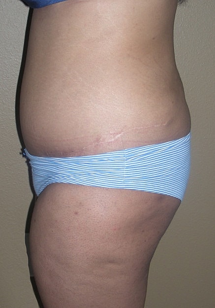 Brazilian Butt Lift Before & After