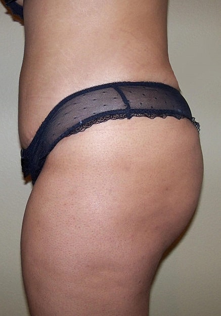 Brazilian Butt Lift Before & After