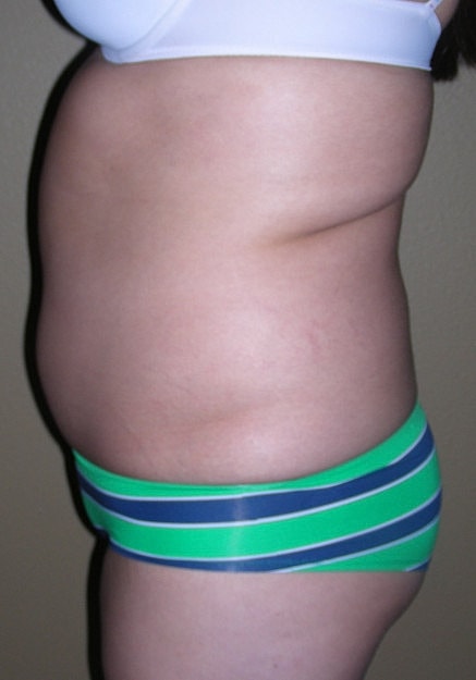 Brazilian Butt Lift Before & After