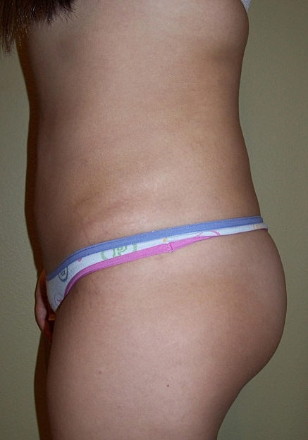 Brazilian Butt Lift Before & After