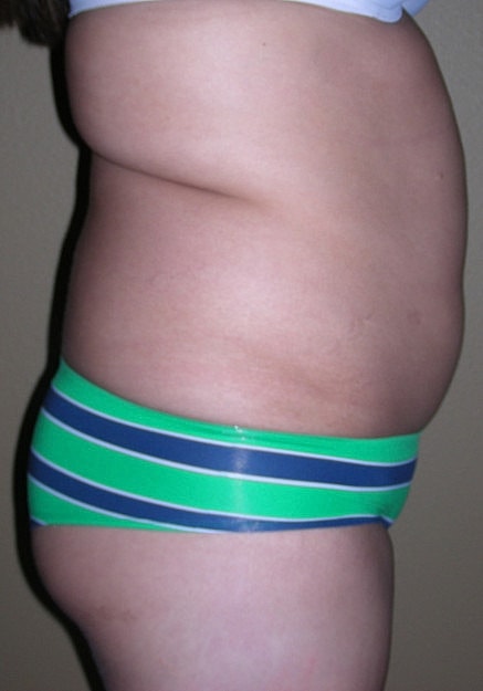 Brazilian Butt Lift Before & After