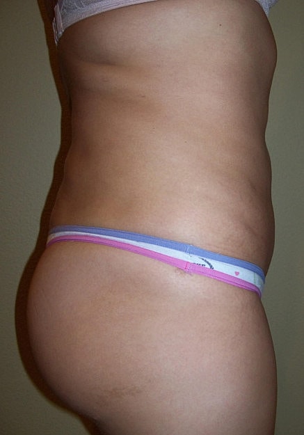 Brazilian Butt Lift Before & After