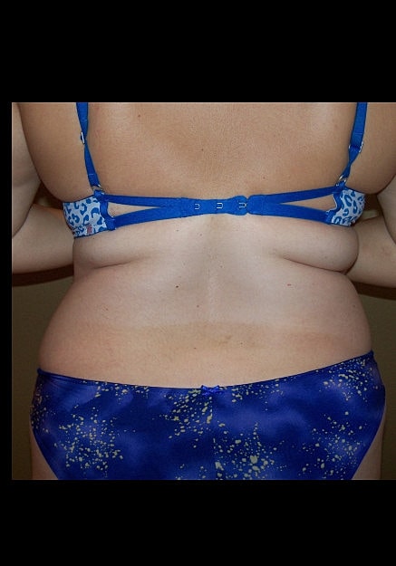Brazilian Butt Lift Before & After