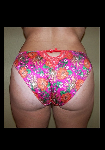 Brazilian Butt Lift Before & After