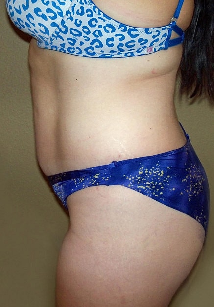 Brazilian Butt Lift Before & After