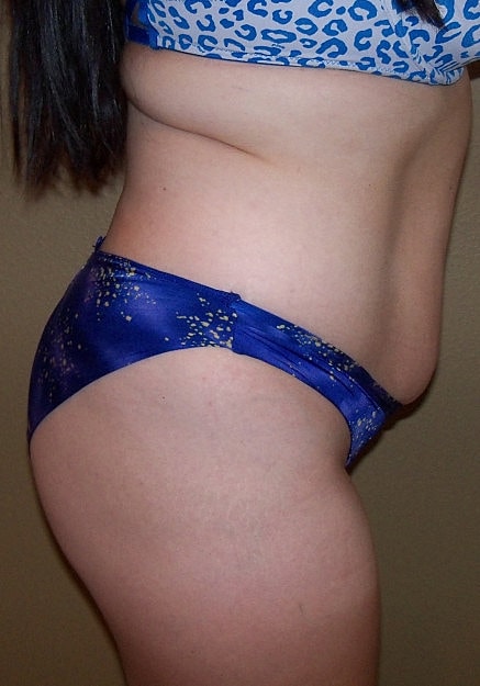 Brazilian Butt Lift Before & After