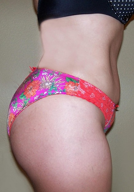 Brazilian Butt Lift Before & After