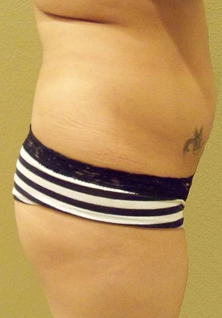 Brazilian Butt Lift Before & After
