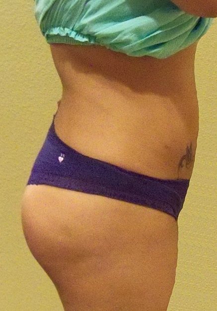 Brazilian Butt Lift Before & After