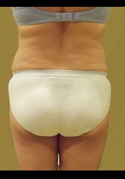 Brazilian Butt Lift Before & After
