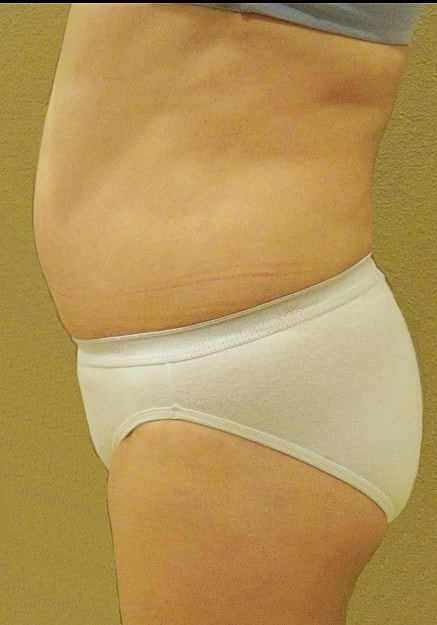 Brazilian Butt Lift Before & After