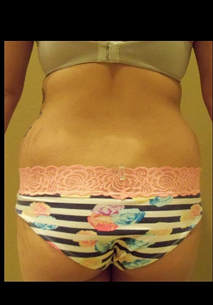 Brazilian Butt Lift Before & After