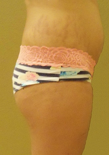 Brazilian Butt Lift Before & After