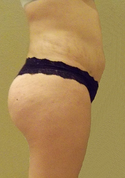 Brazilian Butt Lift Before & After