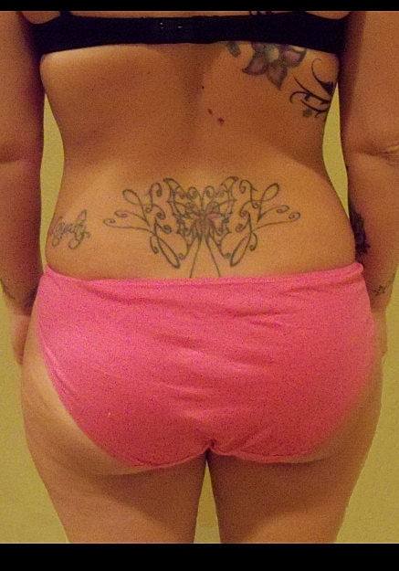 Brazilian Butt Lift Before & After