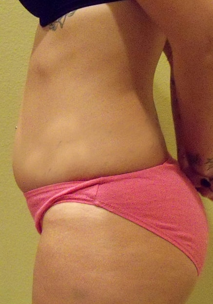 Brazilian Butt Lift Before & After