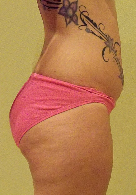 Brazilian Butt Lift Before & After