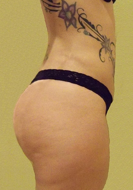 Brazilian Butt Lift Before & After