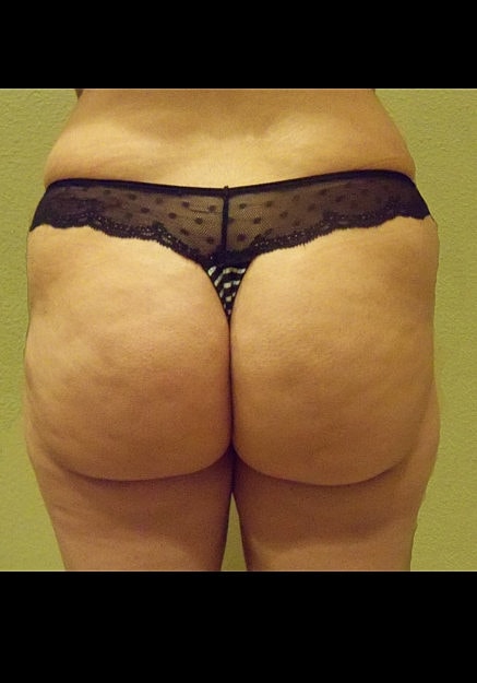 Brazilian Butt Lift Before & After