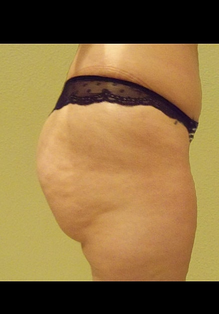 Brazilian Butt Lift Before & After
