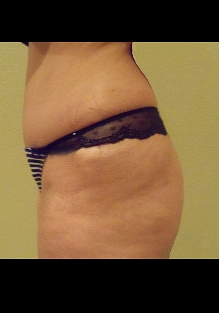 Brazilian Butt Lift Before & After