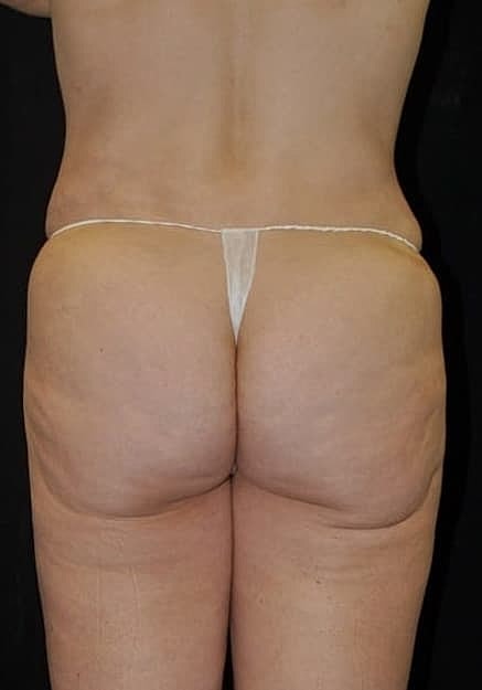 Brazilian Butt Lift Before & After