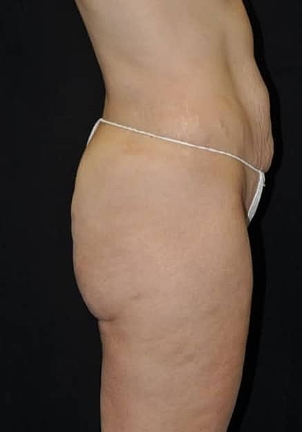 Brazilian Butt Lift Before & After