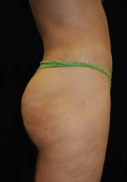 Brazilian Butt Lift Before & After