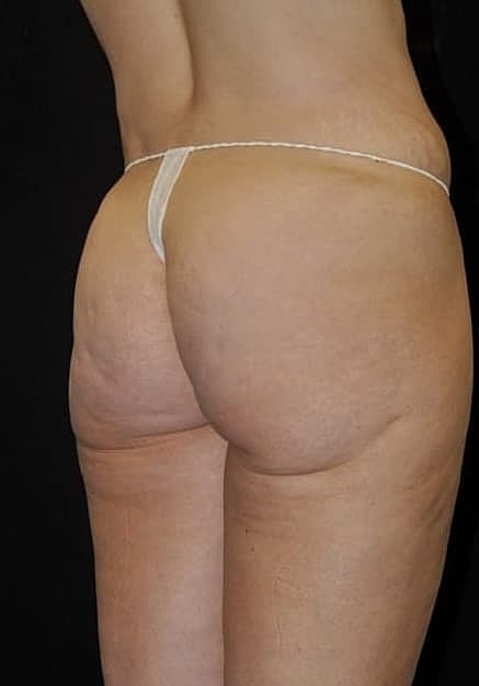 Brazilian Butt Lift Before & After