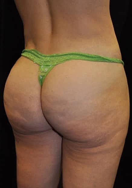Brazilian Butt Lift Before & After