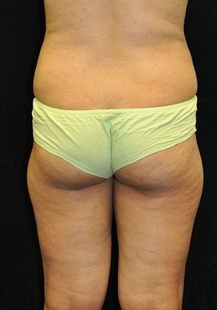 Brazilian Butt Lift Before & After