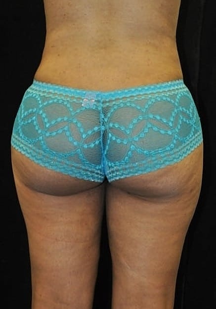 Brazilian Butt Lift Before & After