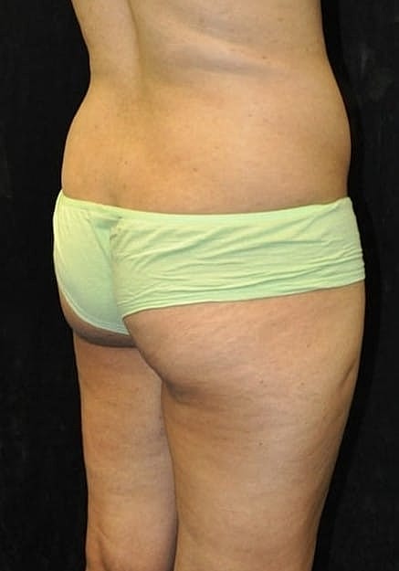 Brazilian Butt Lift Before & After
