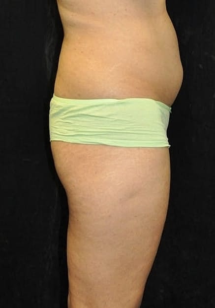 Brazilian Butt Lift Before & After