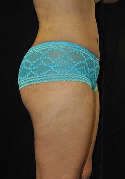 Brazilian Butt Lift Before & After