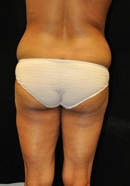 Brazilian Butt Lift Before & After