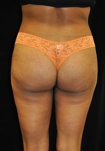 Brazilian Butt Lift Before & After