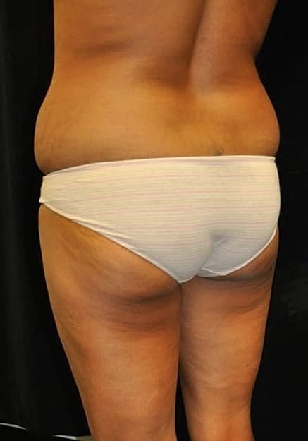 Brazilian Butt Lift Before & After