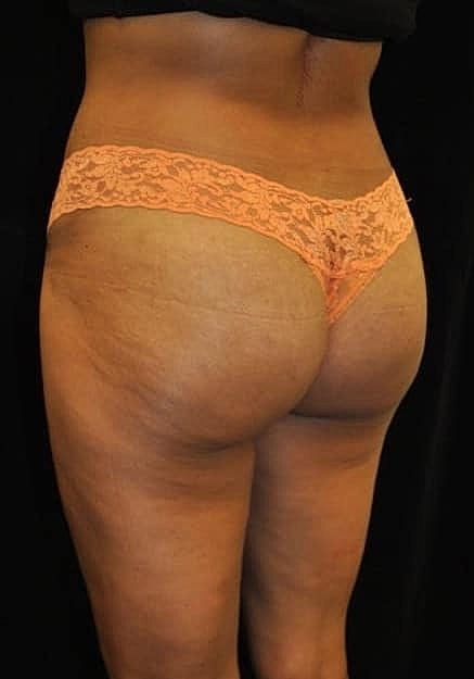Brazilian Butt Lift Before & After