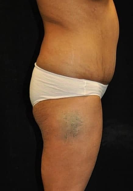 Brazilian Butt Lift Before & After