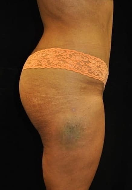 Brazilian Butt Lift Before & After
