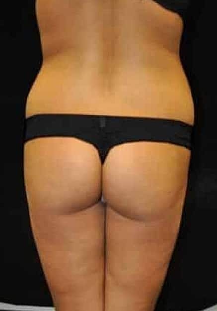 Brazilian Butt Lift Before & After