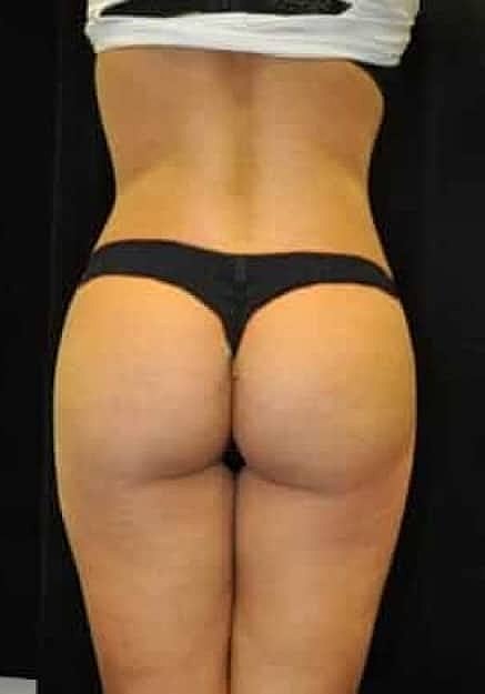 Brazilian Butt Lift Before & After