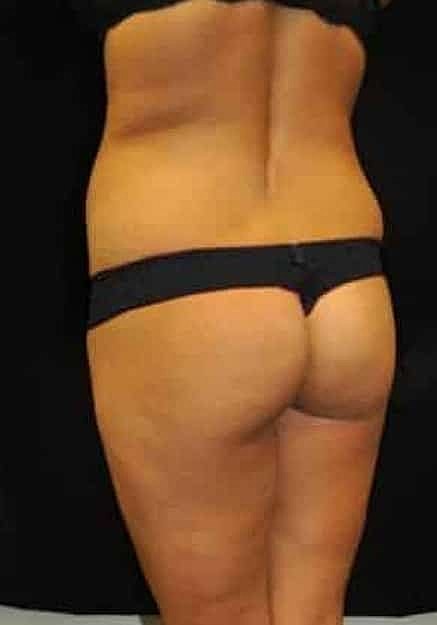 Brazilian Butt Lift Before & After
