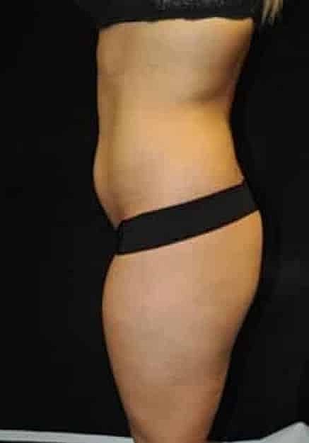 Brazilian Butt Lift Before & After