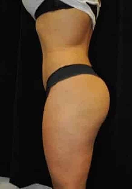 Brazilian Butt Lift Before & After