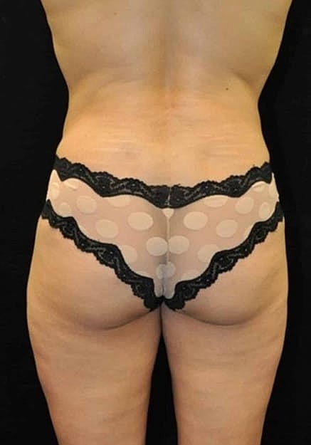 Brazilian Butt Lift Before & After